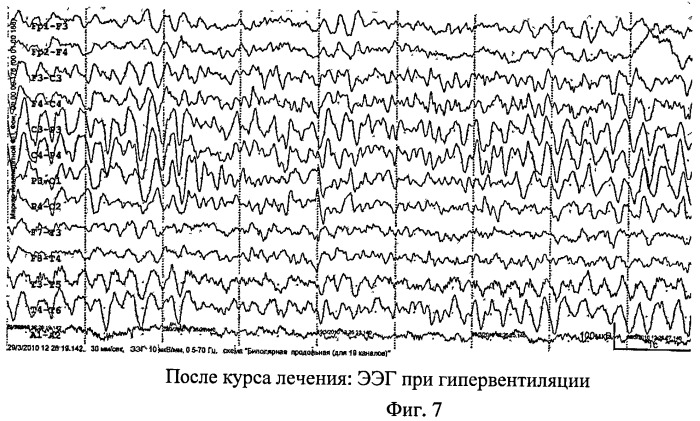 Способ лечения гиперкинетического расстройства у детей (патент 2476250)