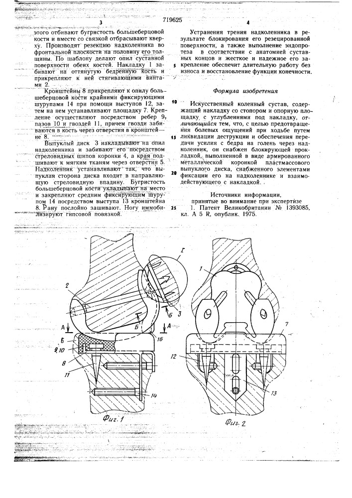 Искусственный коленный сустав (патент 719625)