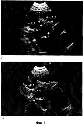 Способ ультразвуковой диагностики коарктации аорты (патент 2244512)