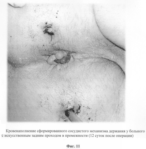 Способ восстановления сосудистого механизма держания при формировании искусственного заднего прохода (патент 2292846)