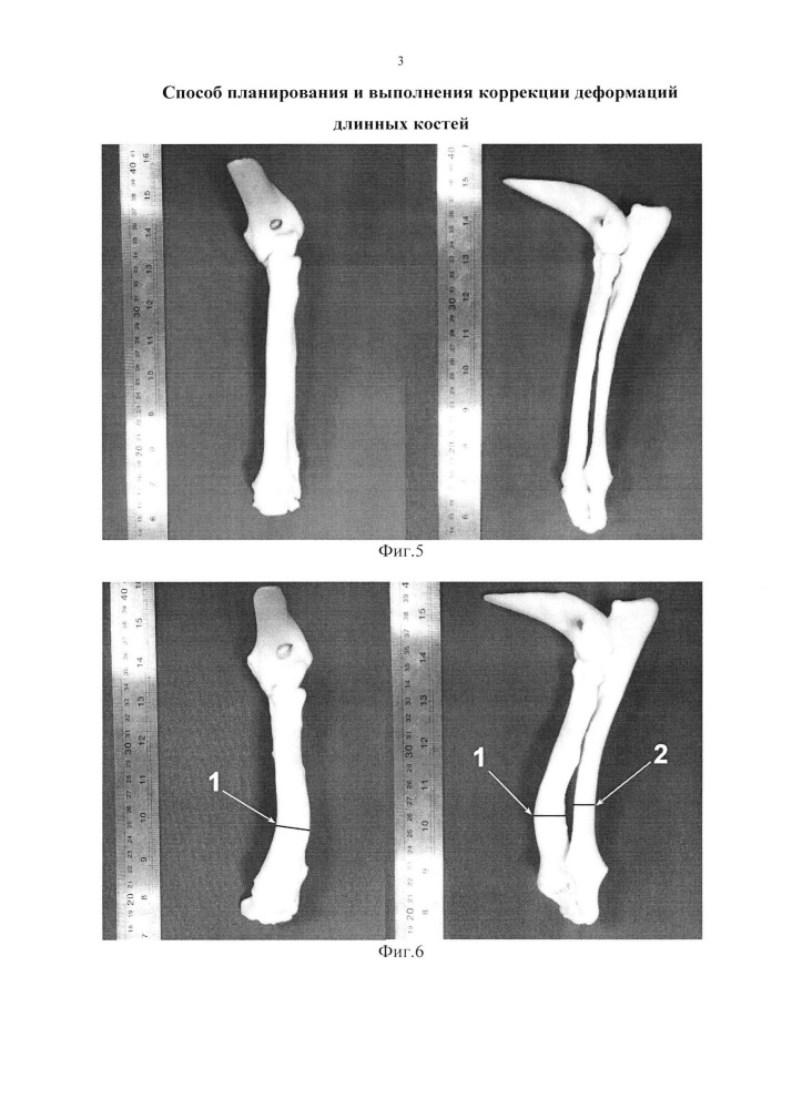 Способ планирования и выполнения коррекции деформаций длинных костей (патент 2641840)
