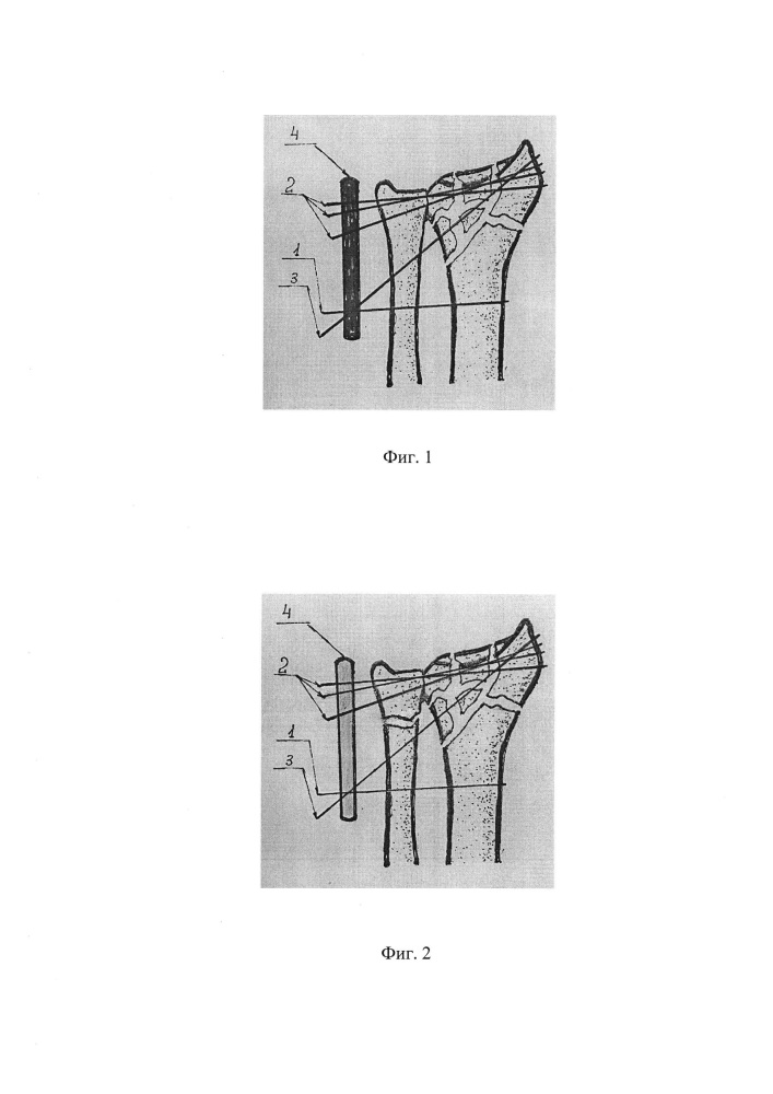 Способ лечения переломов дистального отдела предплечья (патент 2644848)