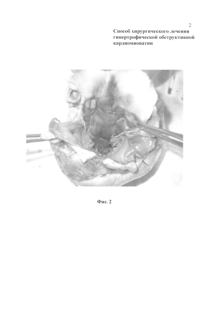 Способ хирургического лечения гипертрофической обструктивной кардиомиопатии (патент 2608705)