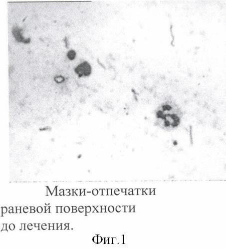 Способ лечения раневых поверхностей (патент 2360678)