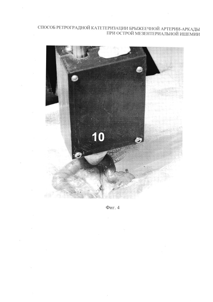 Способ ретроградной катетеризации брыжеечной артерии-аркады при острой мезентериальной ишемии (патент 2635486)