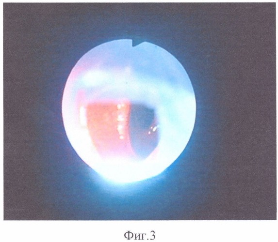 Способ эндоскопического введения видеокапсулы в желудок и двенадцатиперстную кишку и устройство для его осуществления (патент 2344785)