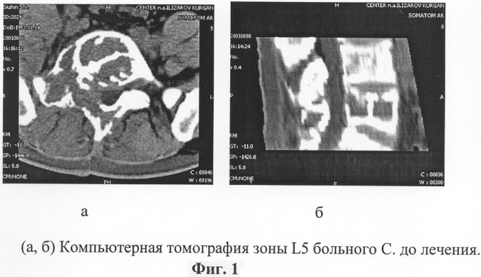 Способ хирургического лечения опухолей позвоночника (патент 2279860)