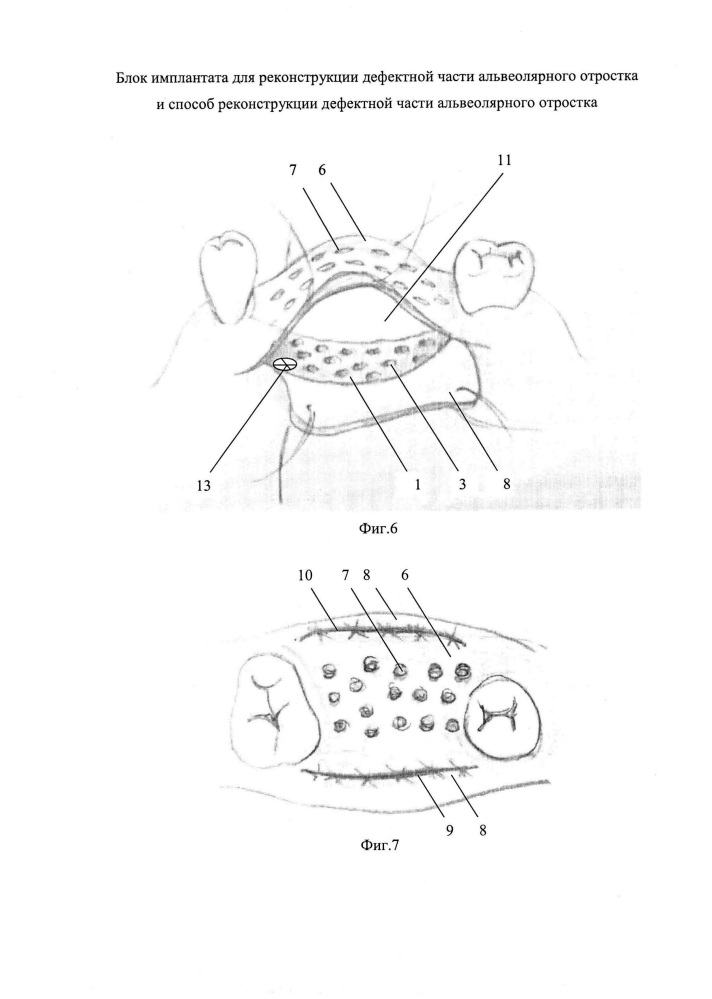 Блок имплантата для реконструкции дефектной части альвеолярного отростка и способ реконструкции дефектной части альвеолярного отростка (патент 2612826)