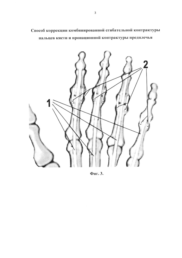Способ коррекции комбинированной сгибательной контрактуры трехфаланговых пальцев кисти и пронационной контрактуры предплечья (патент 2627290)