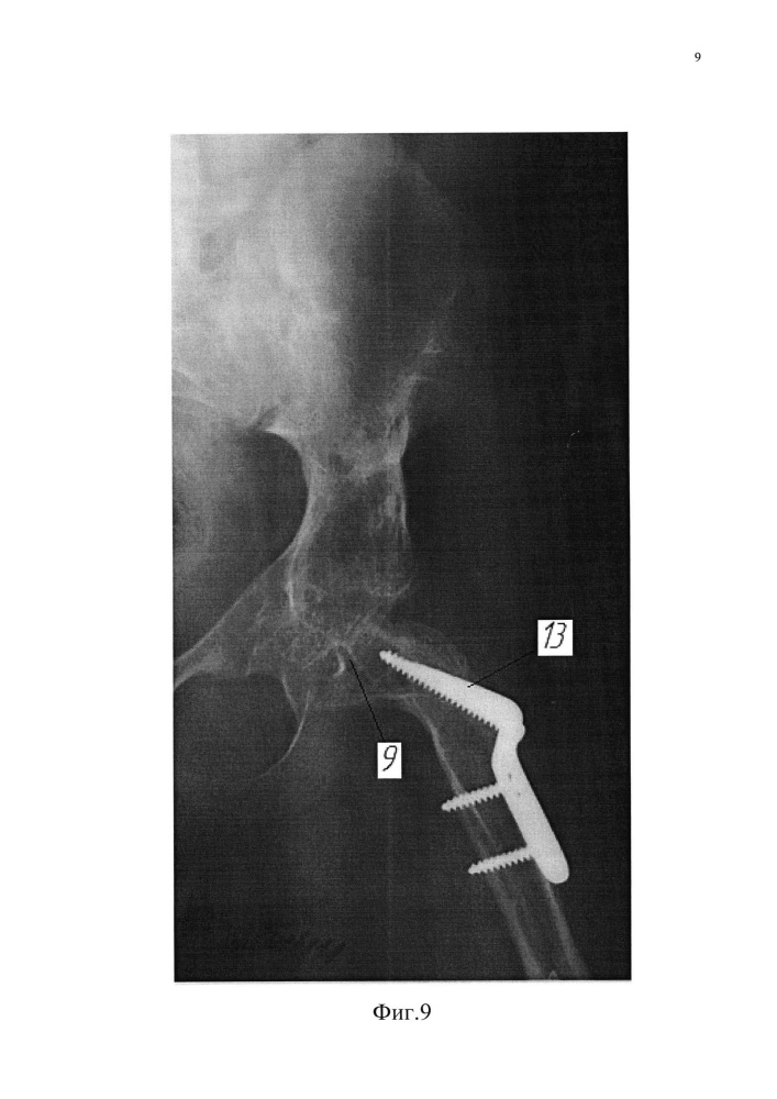 Способ лечения дефекта проксимального отдела бедра (патент 2621538)