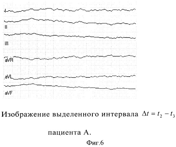 Способ выделения начала кардиоцикла (патент 2359606)