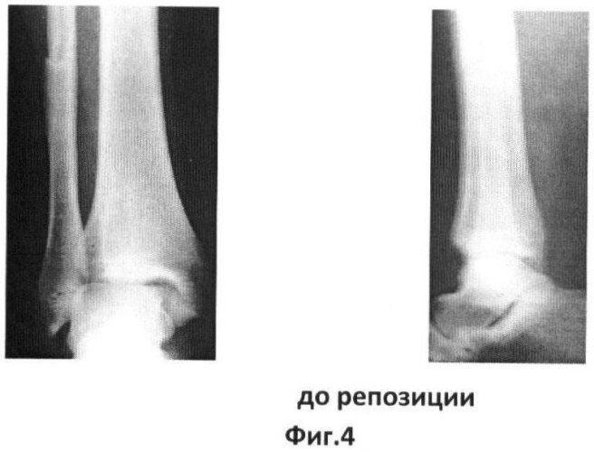 Способ закрытой управляемой динамической аппаратной репозиции переломовывихов в голеностопном суставе при их внутрисуставной костной интерпозиции (патент 2415656)