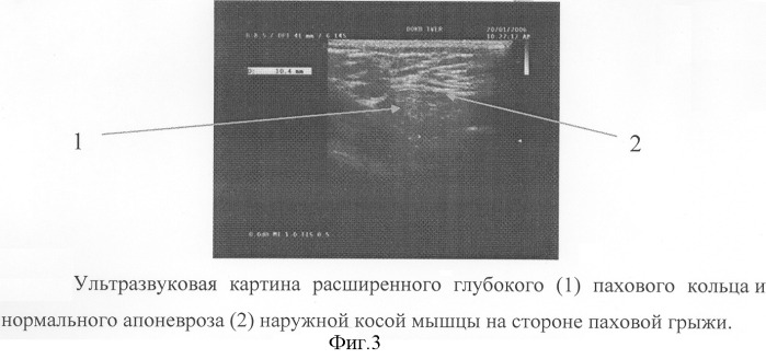 Способ определения показаний к выбору метода оперативного лечения паховых грыж у детей (патент 2303409)