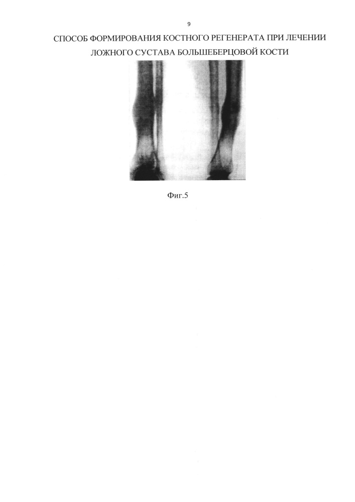 Способ формирования костного регенерата при лечении ложного сустава большеберцовой кости (патент 2645941)