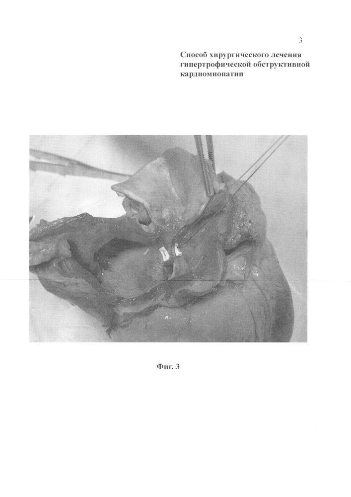 Способ хирургического лечения гипертрофической обструктивной кардиомиопатии (патент 2608705)