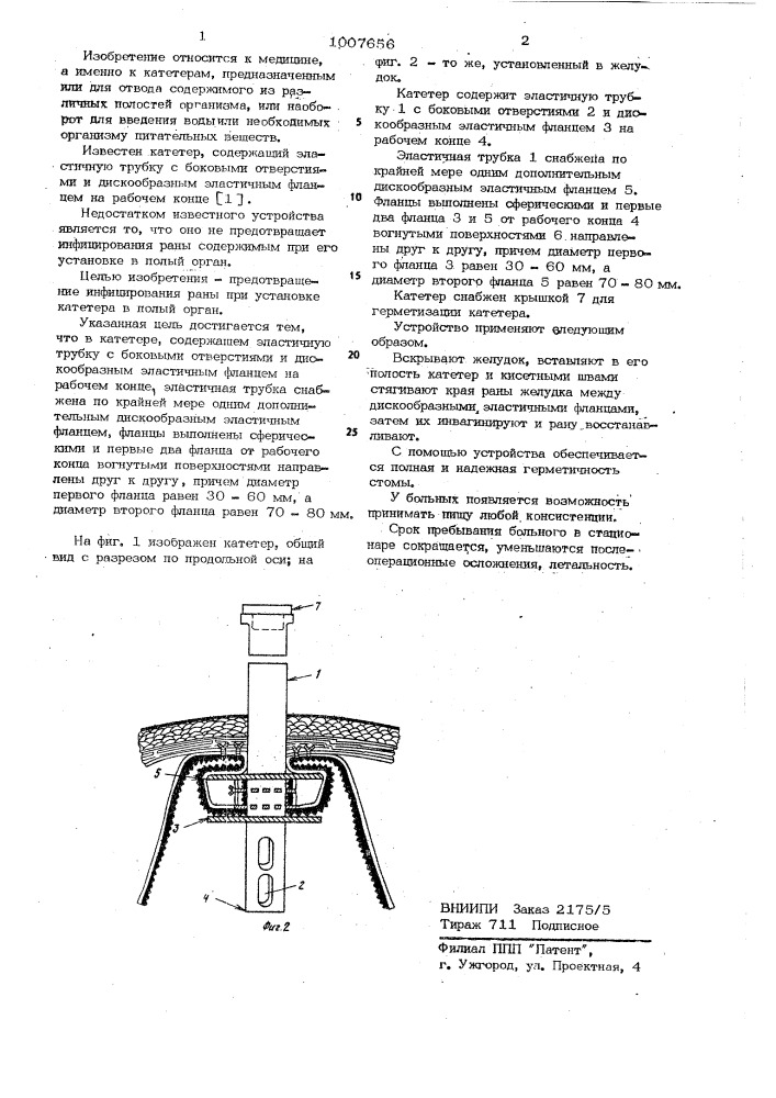 Катетер (патент 1007656)