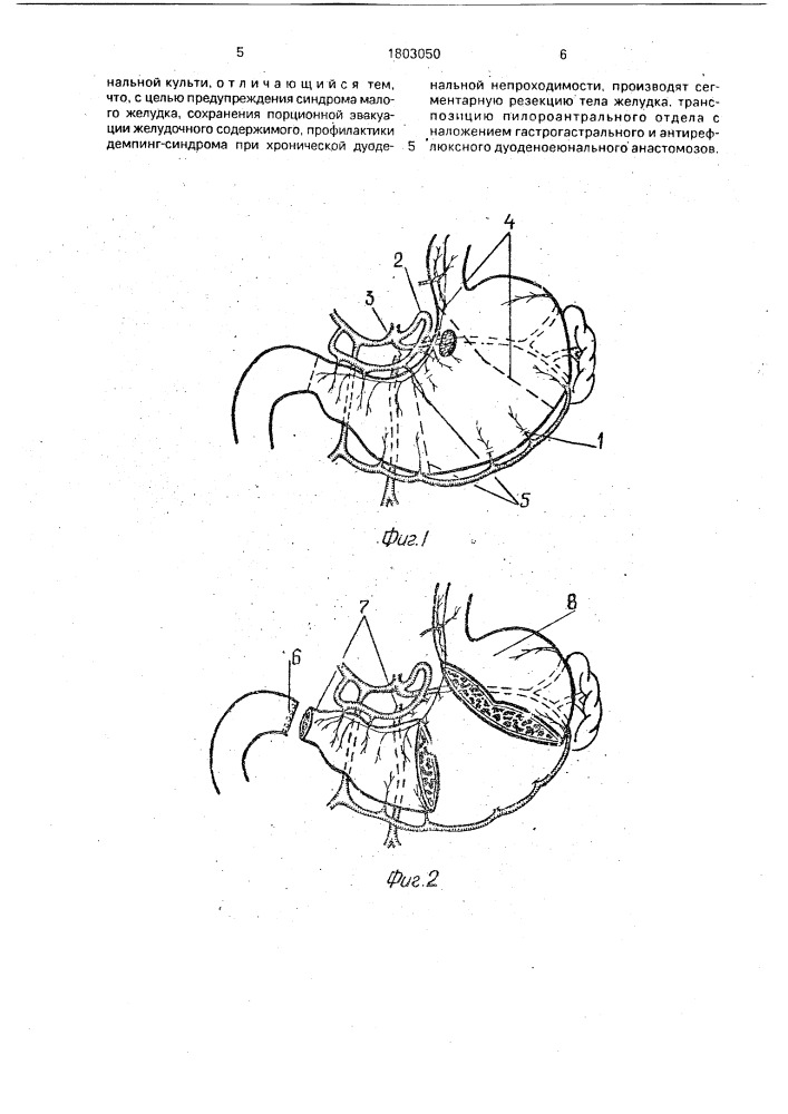 Способ резекции желудка (патент 1803050)