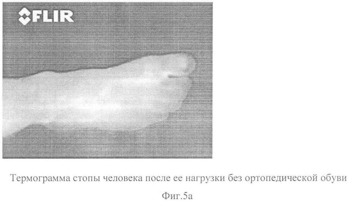 Способ оценки эффективности ортопедической коррекции стопы (патент 2357705)