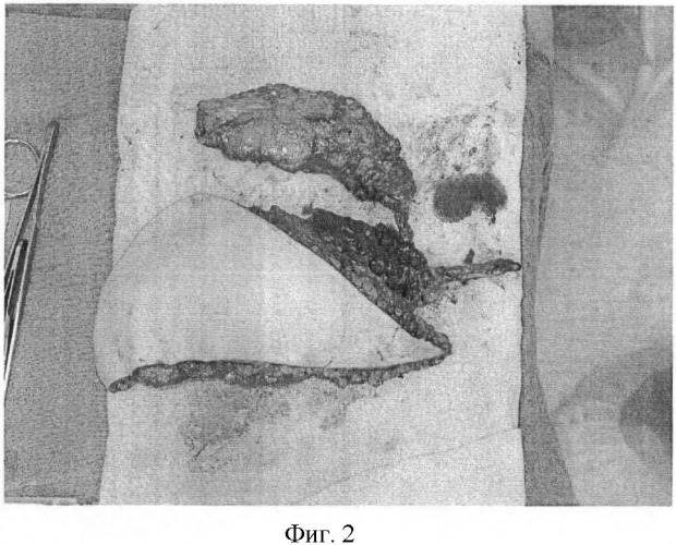 Способ лечения остеомиелита длинных трубчатых костей с дефектом покровных тканей (патент 2369348)