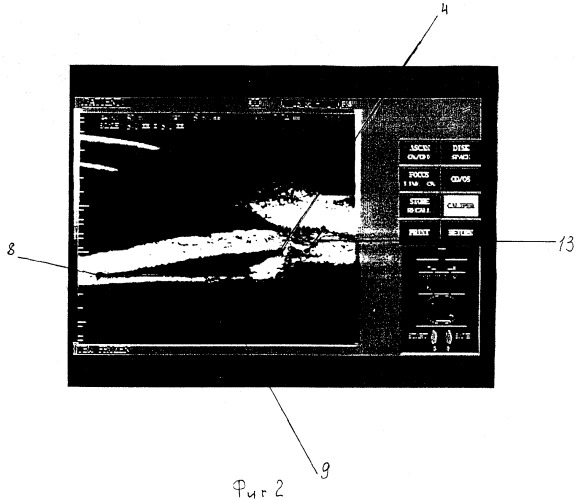 Способ ранней доклинической диагностики разрыва волокон цинновой связки (патент 2281696)