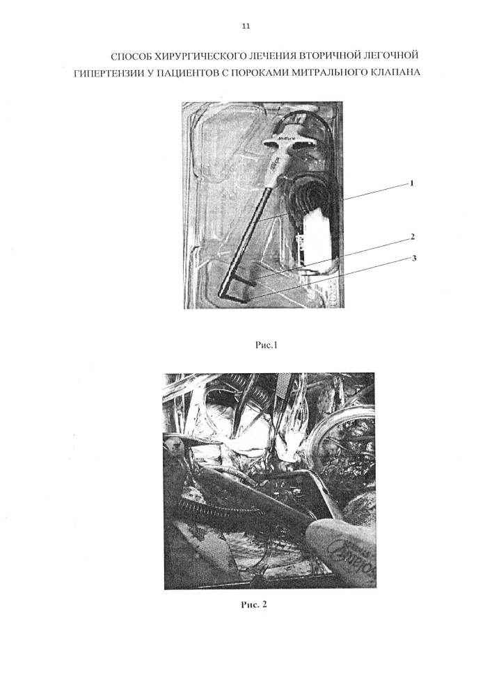 Способ хирургического лечения вторичной легочной гипертензии у пациентов с пороками митрального клапана (патент 2661710)