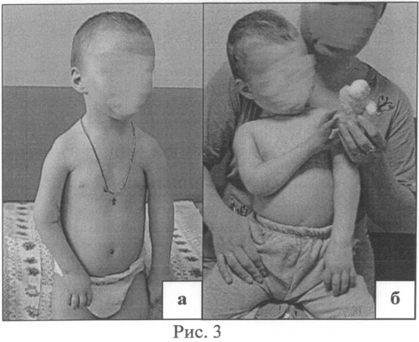 Способ транспозиции длинной головки трехглавой мышцы плеча в позицию двуглавой мышцы плеча у детей с артрогрипозом (патент 2503423)