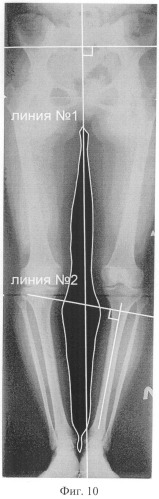 Способ предоперационного планирования корригирующих остеотомий костей голени для исправления о-образной формы ног (патент 2547252)