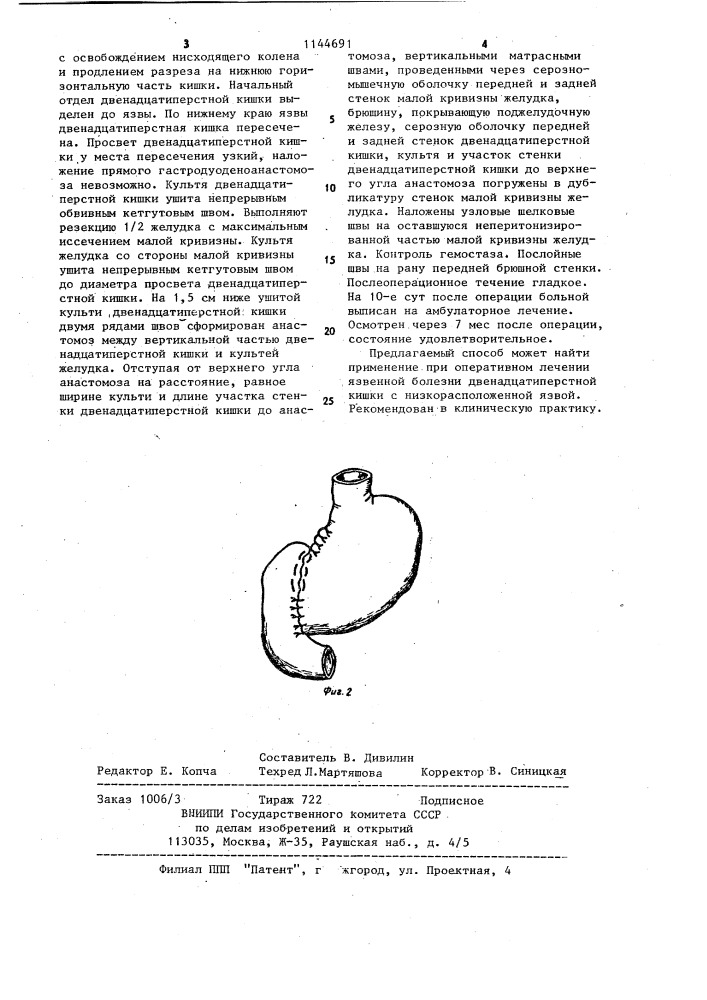 Способ резекции желудка (патент 1144691)