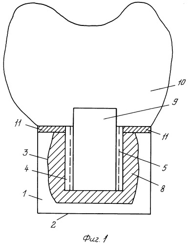 Разборный зубной имплантат (патент 2296531)