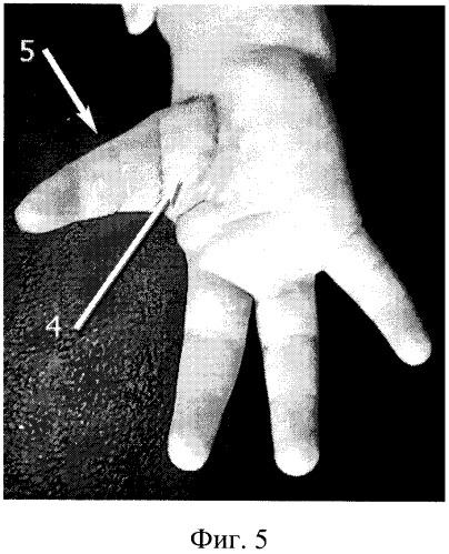 Способ реконструкции кисти у детей с гипоплазией первого пальца (патент 2269962)