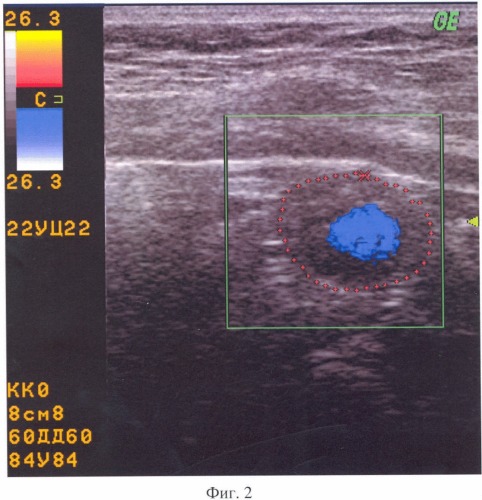 Способ ультразвуковой диагностики дуоденогастрального рефлюкса (патент 2332169)