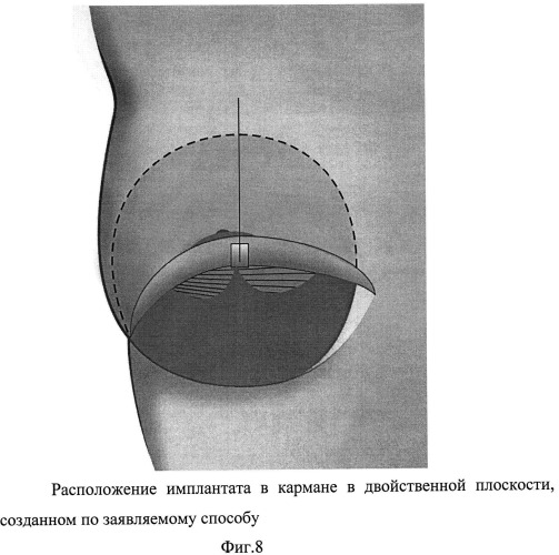 Способ формирования кармана для имплантата в двойственной плоскости при аугментационной маммопластике (патент 2498777)