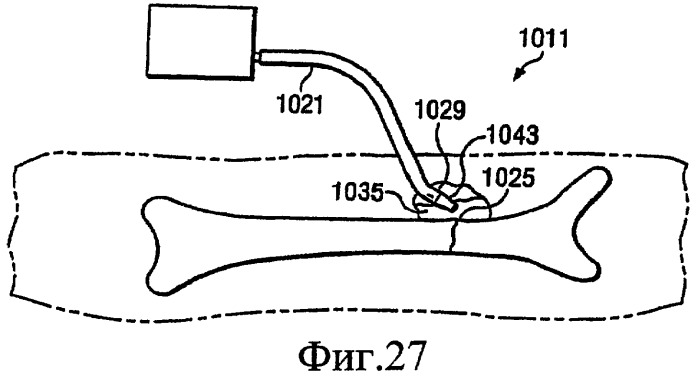 Устройство для лечения путем подачи пониженного давления, содержащее магистраль с первичным каналом потока и элементом предотвращения закупорок (патент 2410124)