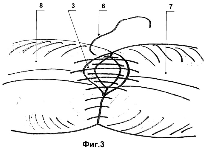 Способ наложения ручного кишечного шва при формировании кишечных анастомозов в абдоминальной хирургии (патент 2432129)