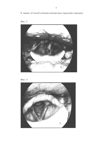 Способ лечения контактных гранулём гортани (патент 2591546)