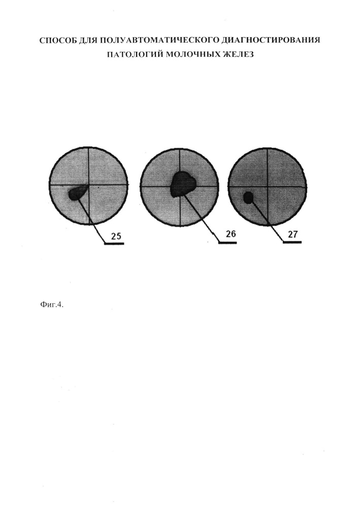 Способ для полуавтоматического диагностирования патологий молочных желёз (патент 2622362)