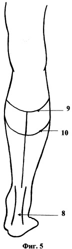 Способ ампутации нижней конечности на уровне голени (патент 2354312)