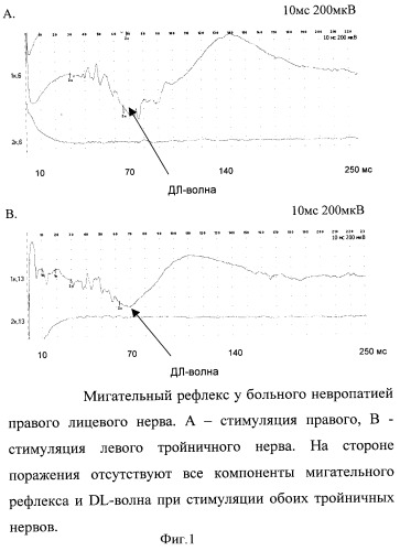 Способ диагностики состояния вегетативной нервной системы при неврологических синдромах лица и головы (патент 2417744)