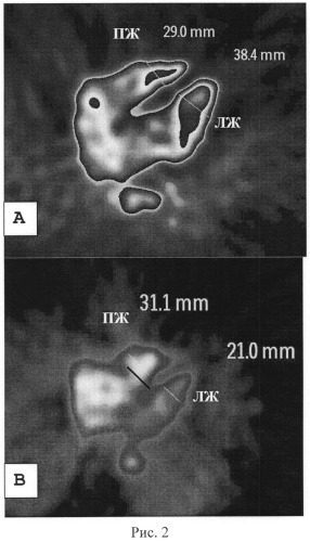 Способ дифференциальной диагностики острой тромбоэмболии легочной артерии и хронической постэмболической легочной гипертензии (патент 2545927)