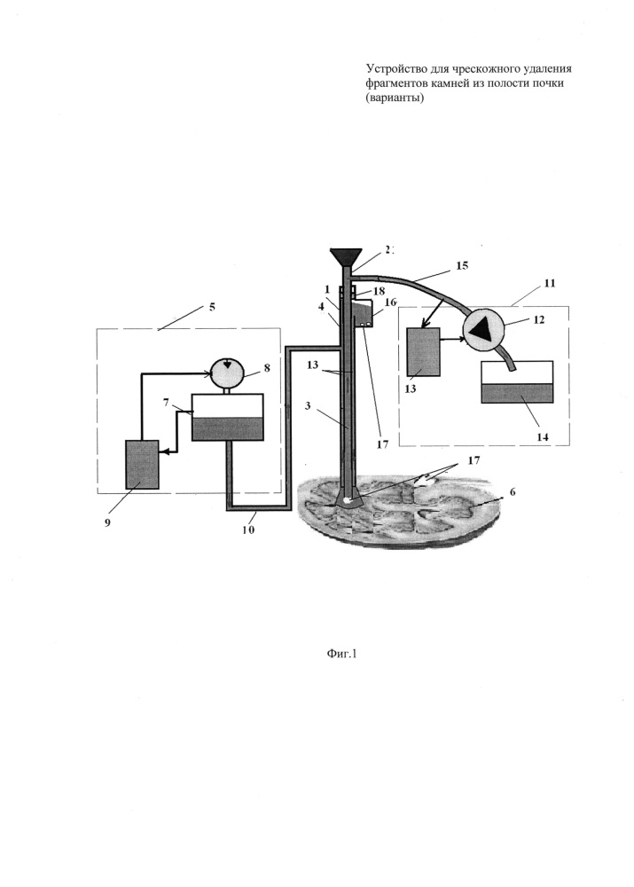Устройство для чрескожного удаления фрагментов камней из полости почки (варианты) (патент 2637820)
