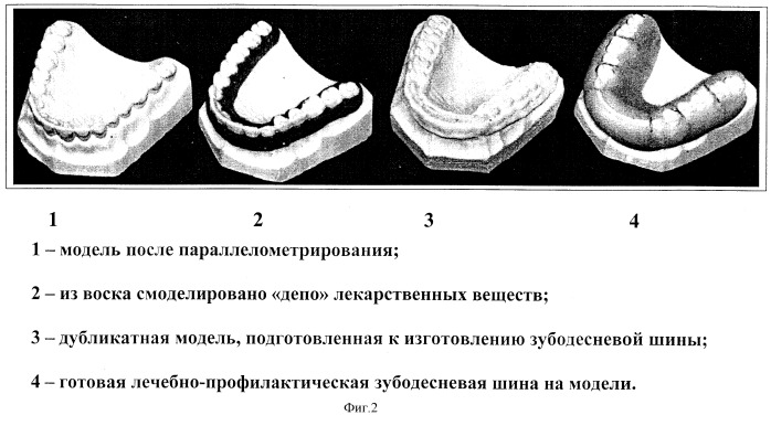 Способ изготовления лечебно-профилактической зубодесневой шины (патент 2249441)