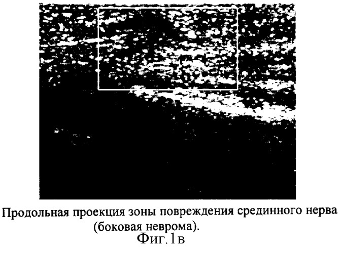 Способ ультразвуковой диагностики перерыва срединного и локтевого нервов на уровне предплечья и контроля их регенерации после шва (патент 2254808)