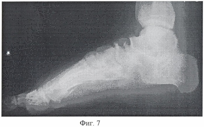Способ оперативной коррекции деформаций стопы (патент 2412661)