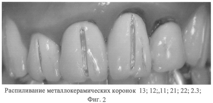 Способ реставрации передних групп зубов при полном отсутствии коронковой части с применением сборного армирующего штифта (патент 2252729)