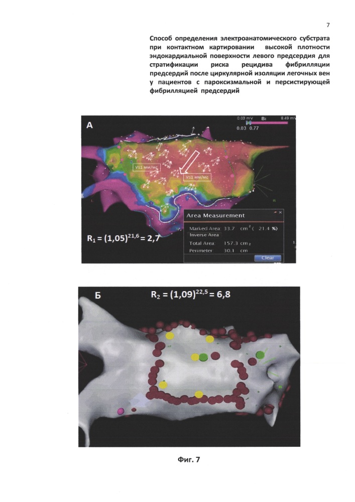 Способ определения электроанатомического субстрата при контактном картировании высокой плотности эндокардиальной поверхности левого предсердия для стратификации риска рецидива фибрилляции предсердий после циркулярной изоляции легочных вен у пациентов с пароксизмальной и персистирующей фибрилляцией предсердий (патент 2649506)