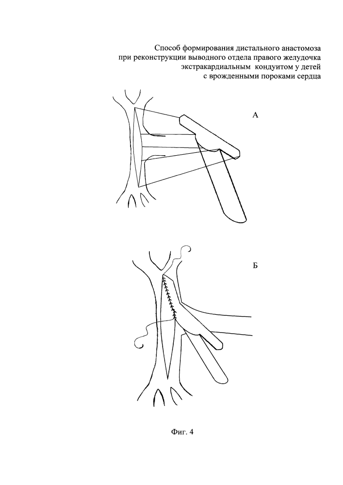 Способ формирования дистального анастомоза при реконструкции выводного отдела правого желудочка экстракардиальным кондуитом у детей с врожденными пороками сердца (патент 2644921)