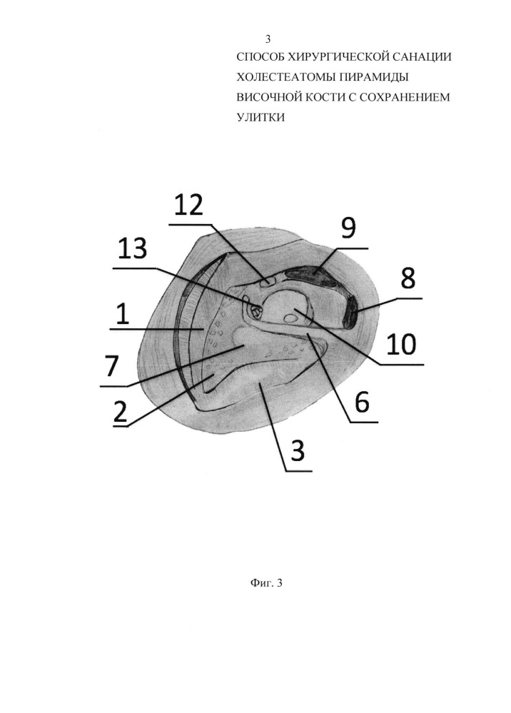 Способ хирургической санации холестеатомы пирамиды височной кости с сохранением улитки (патент 2635470)
