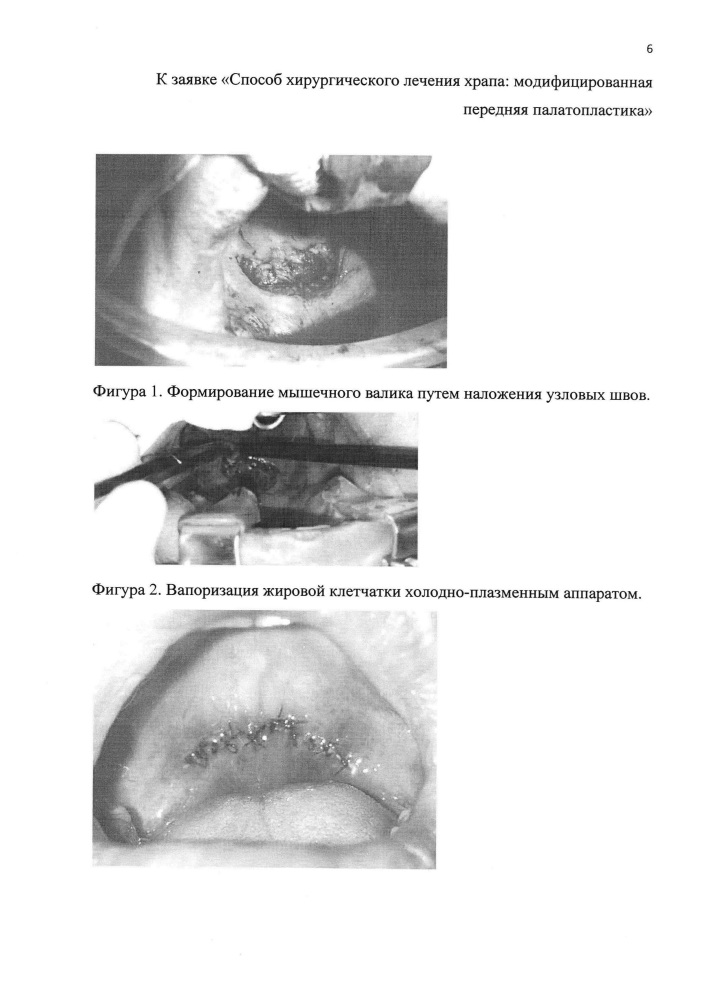 Способ хирургического лечения храпа: модифицированная передняя палатопластика (патент 2632787)