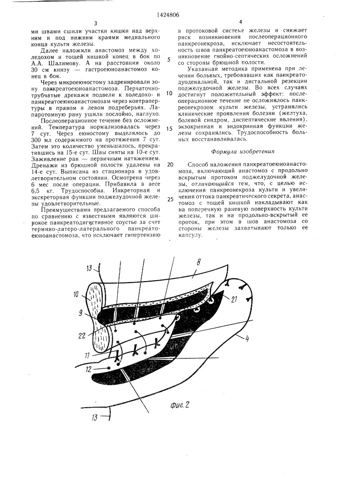 Способ наложения панкреатоеюноанастомоза (патент 1424806)