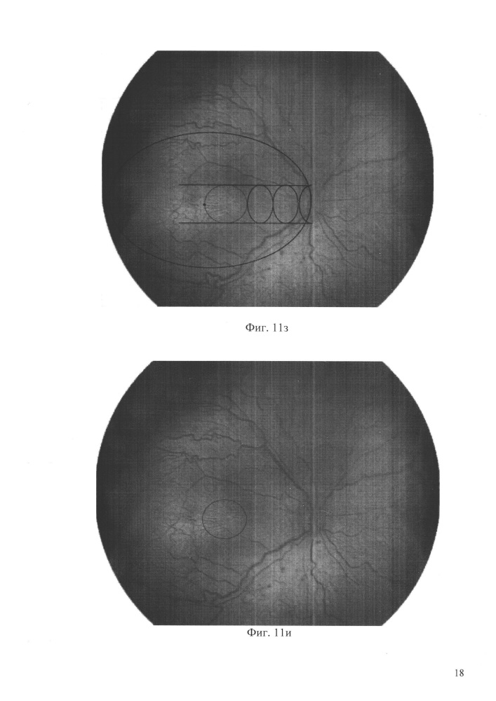 Способ определения локализации макулы при ретинопатии недоношенных (варианты) (патент 2645411)